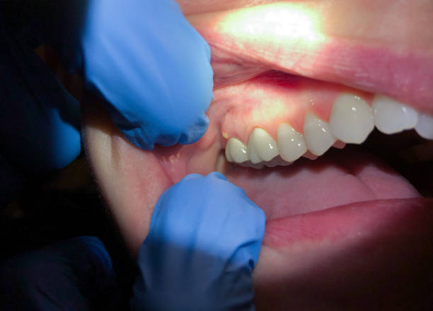 Best Emergency Dental Care for Broken or Chipped Teeth in Eastland, TX